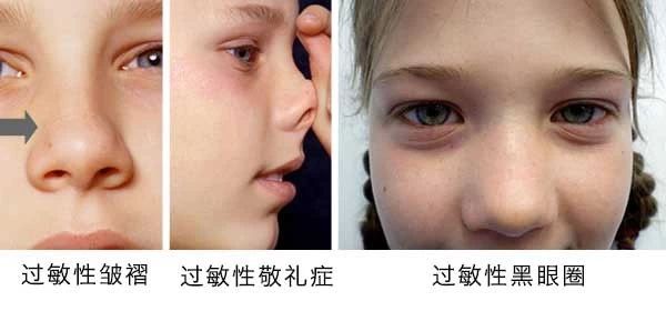 過敏性鼻炎會讓孩子變傻？！家長該如何應對